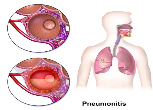 Pleural Disease