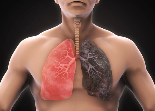 Occupation & Environment Lung Diseases