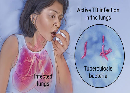 Tuberculosis ( Drug Resistant MRD / X - DR TB & Other )