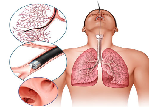 Bronchoscopy