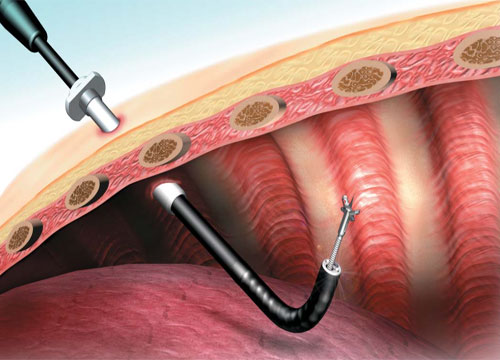 Medical Thoracoscopy (Pleuroscopy)
